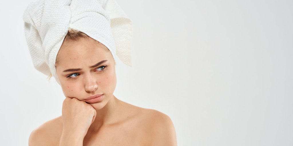4 Reasons You Might Be Suffering from Acne